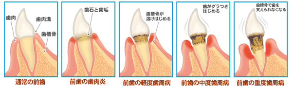 歯周病の流れ